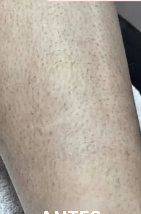 Pierna con vellos enquistados antes de usar la afeitadora
